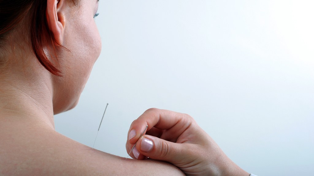 Acupuncture Greeley CO Acupuncture Doctor Near Me Accelerated Rehab