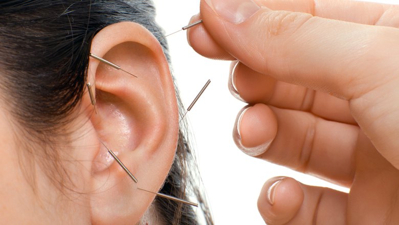 Premier Acupuncture Near Me | Accelerated Rehab Therapy